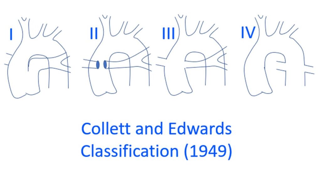 Collet and Edwards classification of Truncus Arteriosus
