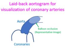 Laid-back aortogram for visualization of coronary arteries
