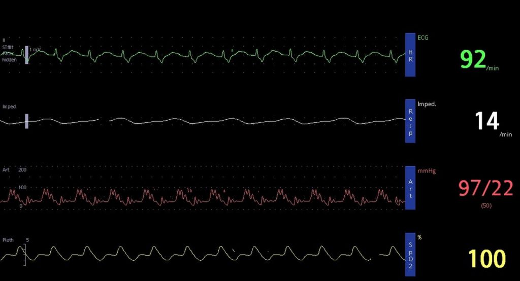 IABP: Intra aortic balloon pump for cardiogenic shock