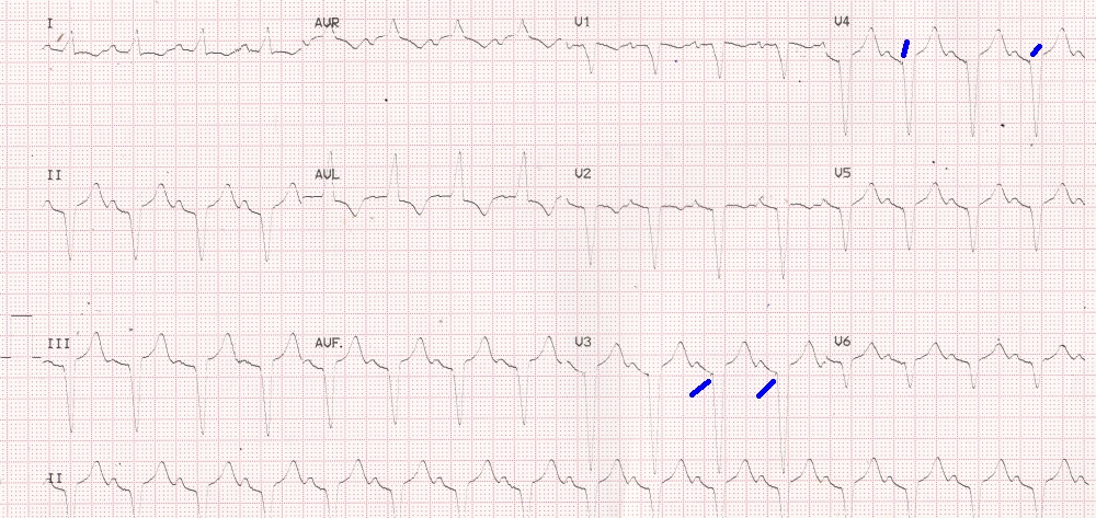 AV sequential pacing (tracking) - All About Cardiovascular System and ...