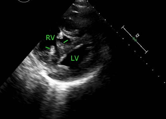 D shaped LV cavity in severe RVH