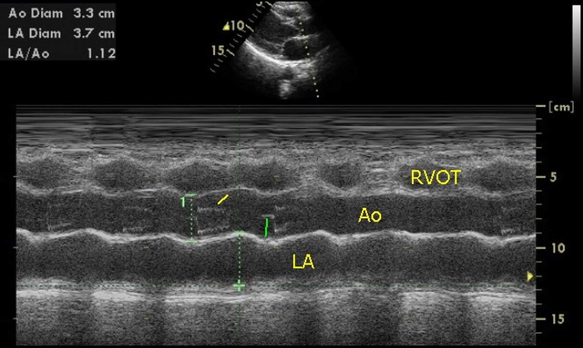 M-Mode echocardiogram at Aorta – Left atrium level