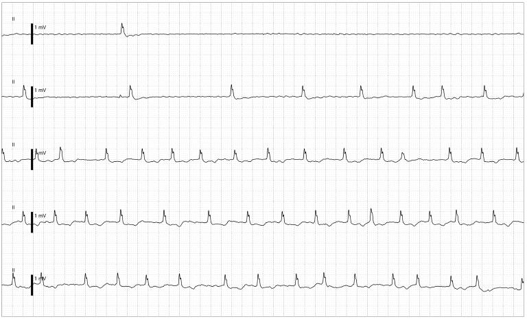 Very long pause noted on ICU monitor