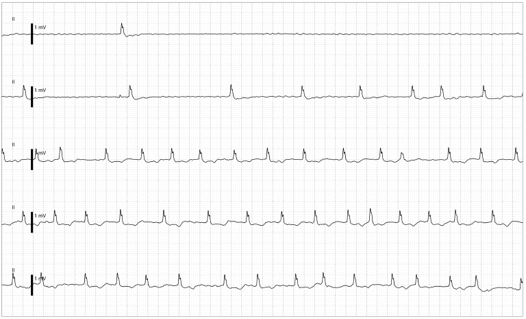 Very long pause noted on ICU monitor: Tachy-Brady syndrome