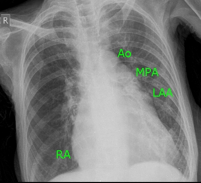 Chest X-ray in Mitral Stenosis with third mogul sign [prominent left atrial appendage (LAA)]