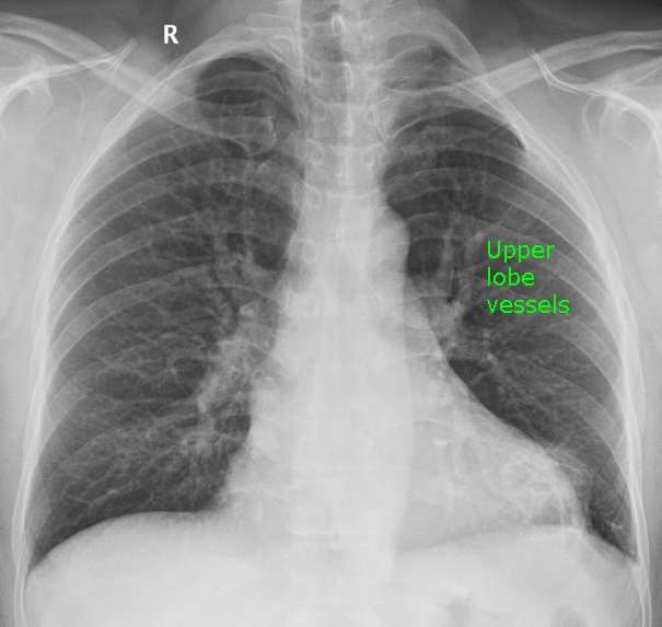 Prominent upper lobe vessels on chest X-ray