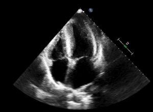 lvh-apical-4c – All About Cardiovascular System and Disorders