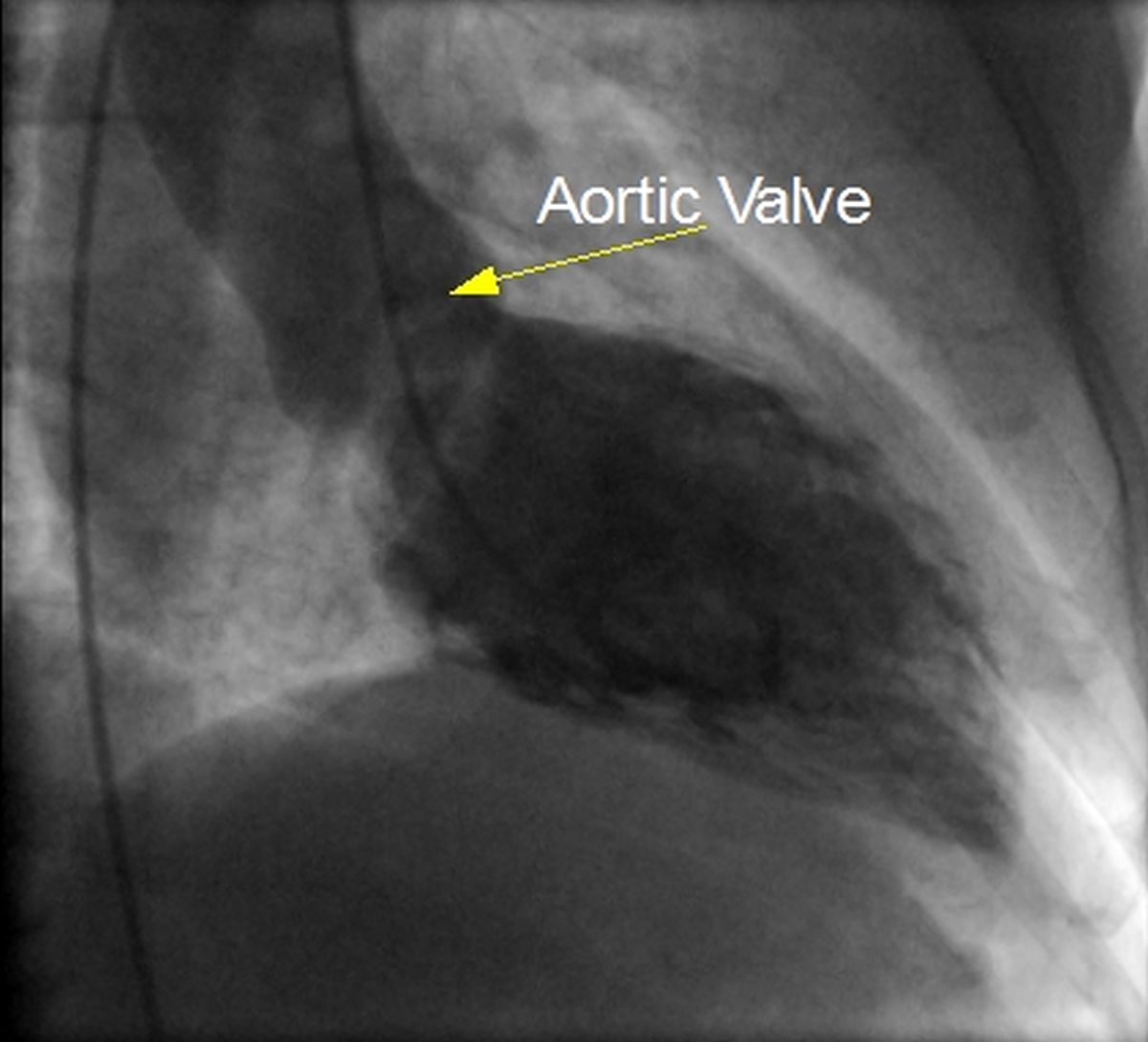 Left ventricular angiogram diastolic frame