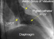Left ventricular angiogram systolic frame in RAO view
