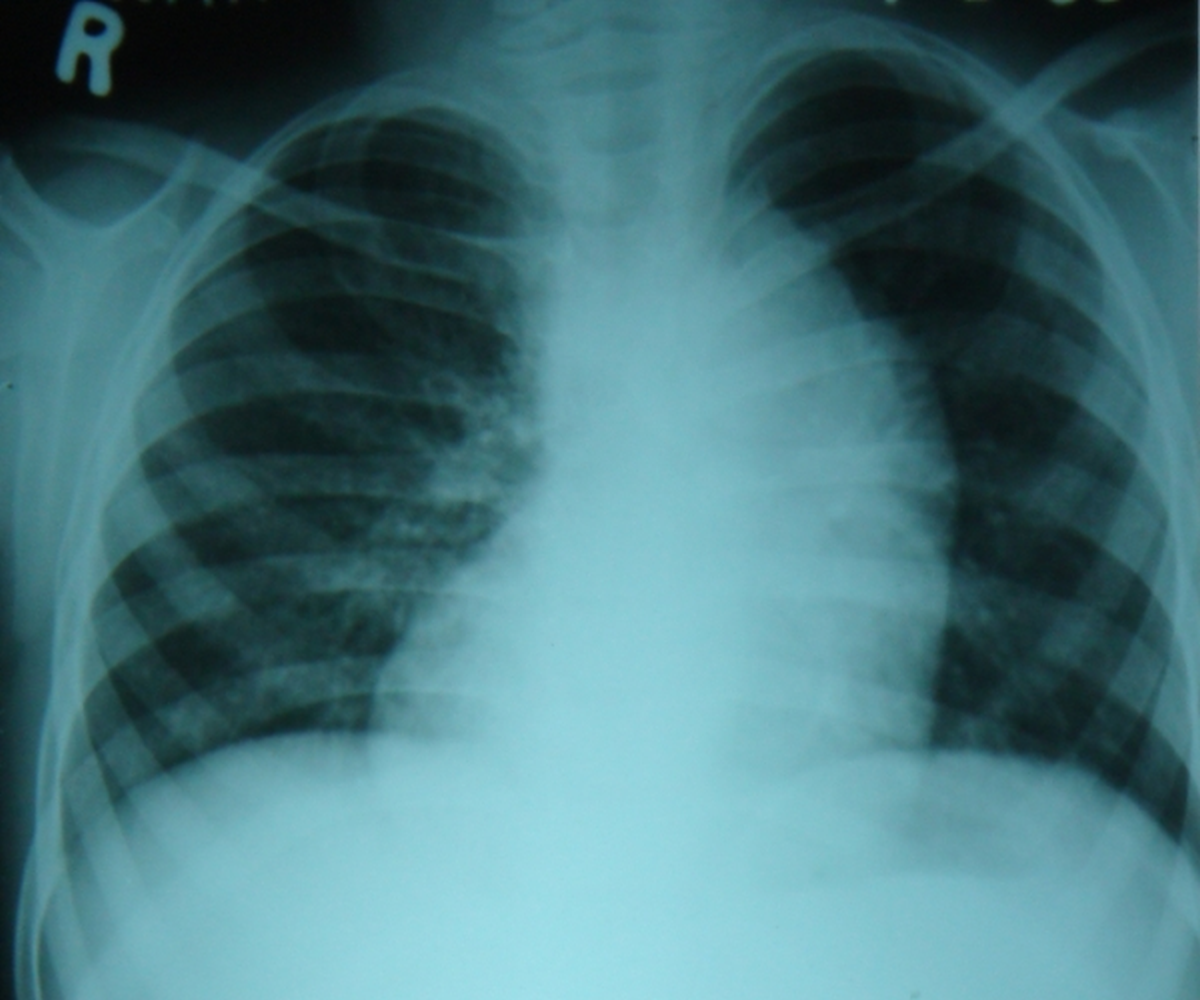 Mesocardia with L-TGA