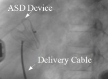 Device closure of ASD