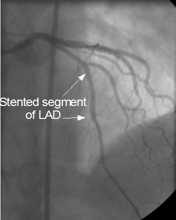 LAD after stent insertion and balloon dilatation