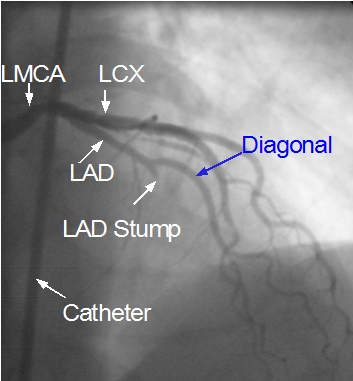 Total occlusion of left anterior descending coronary artery