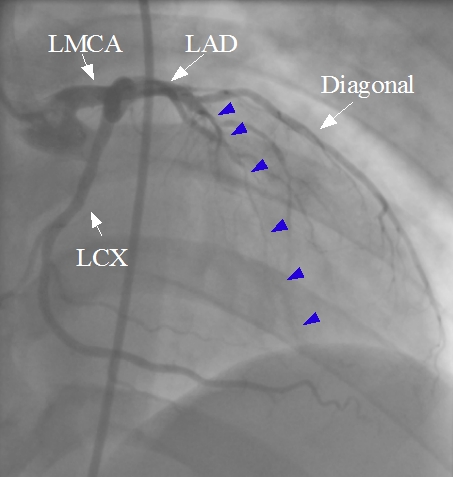 Left coronary angiogram showing near total occlusion of LAD