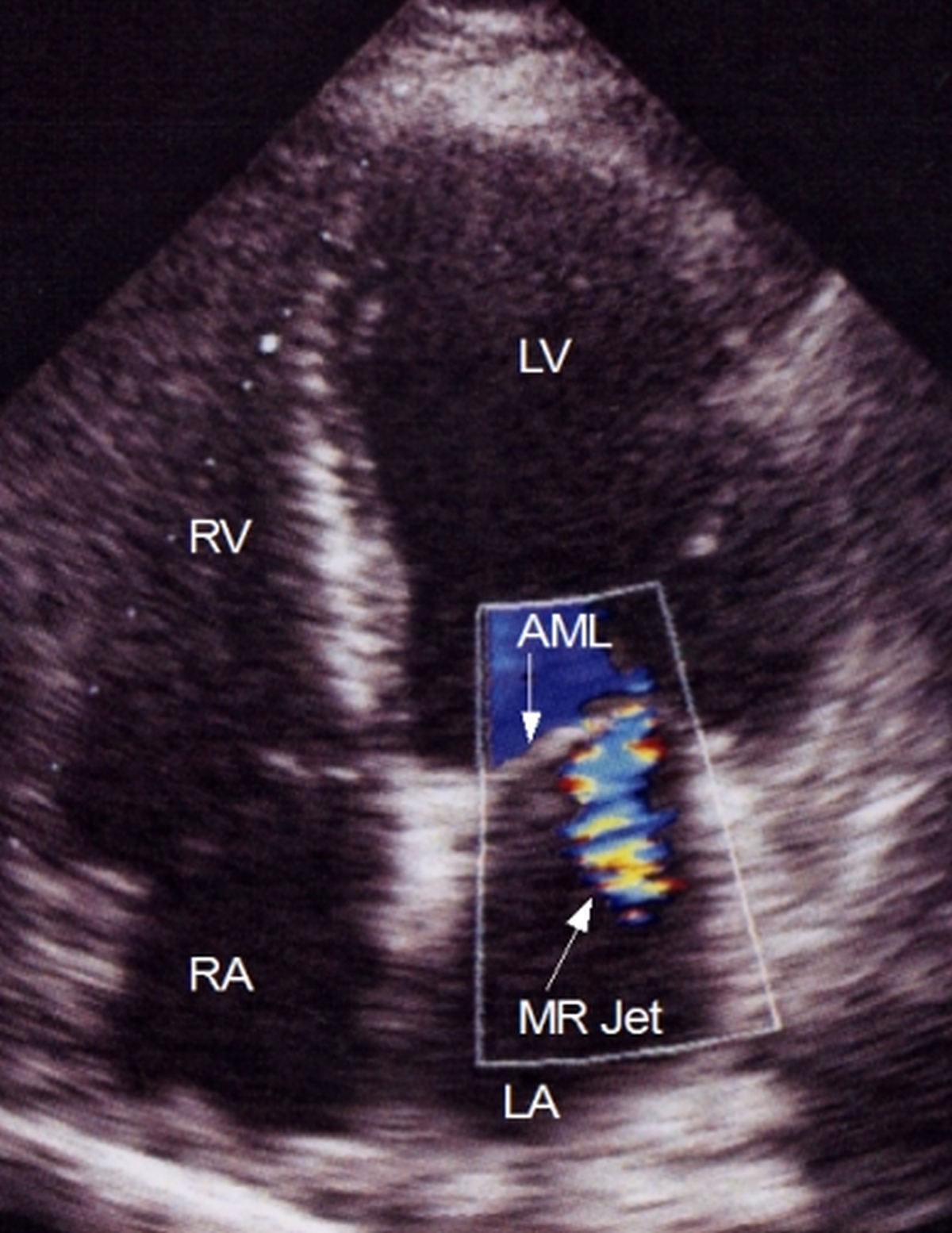 Mitral Regurgitation Jet By Color Doppler Echocardiography