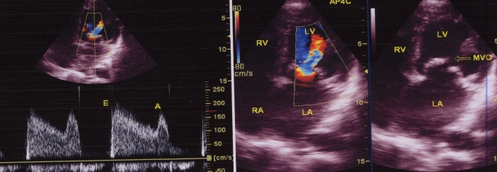 Colour Doppler Echocardiogram in Mitral Stenosis