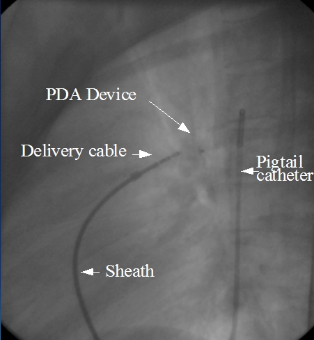 PDA device in position