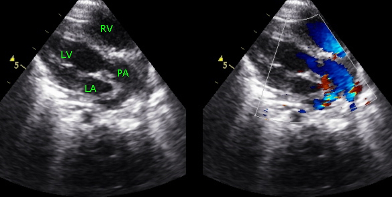 Modified parasternal long axis view in transposition of great arteries, showing the pulmonary artery arising from left ventricle and bifurcating.