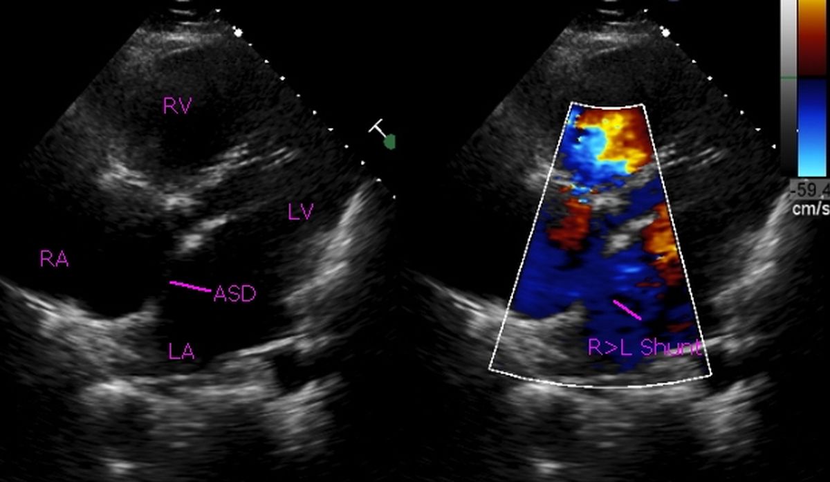 Atrial septal defect (ASD) with bidirectional shunt