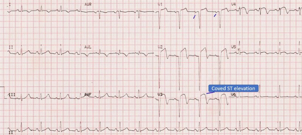 Evolved anterior wall myocardial infarction – All About Cardiovascular ...