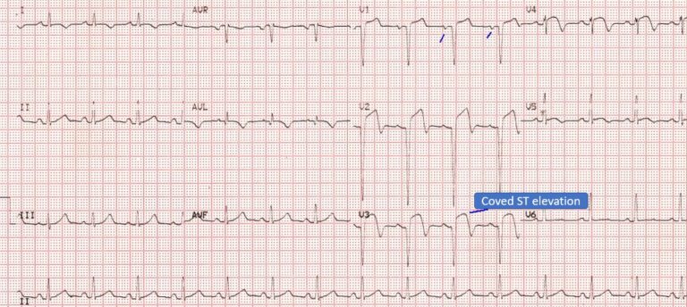 Evolved Anterior Wall Myocardial Infarction – All About Cardiovascular 