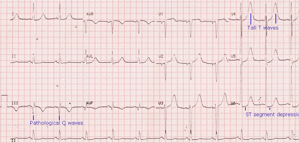 Old inferior wall infarction and lateral ST depression