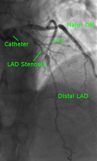 lad-stenosis