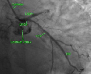 LAD total occlusion – coronary angiogram - transradial angiogram