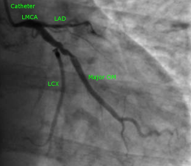 lcx-om-stenosis