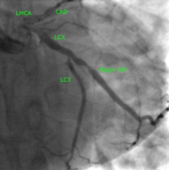 lcx-om-stenosis2