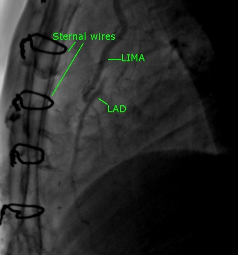 Coronary Angiographic Views All About Cardiovascular System And Disorders coronary-angiographic-views-all-about-cardiovascular-system-and-disorders