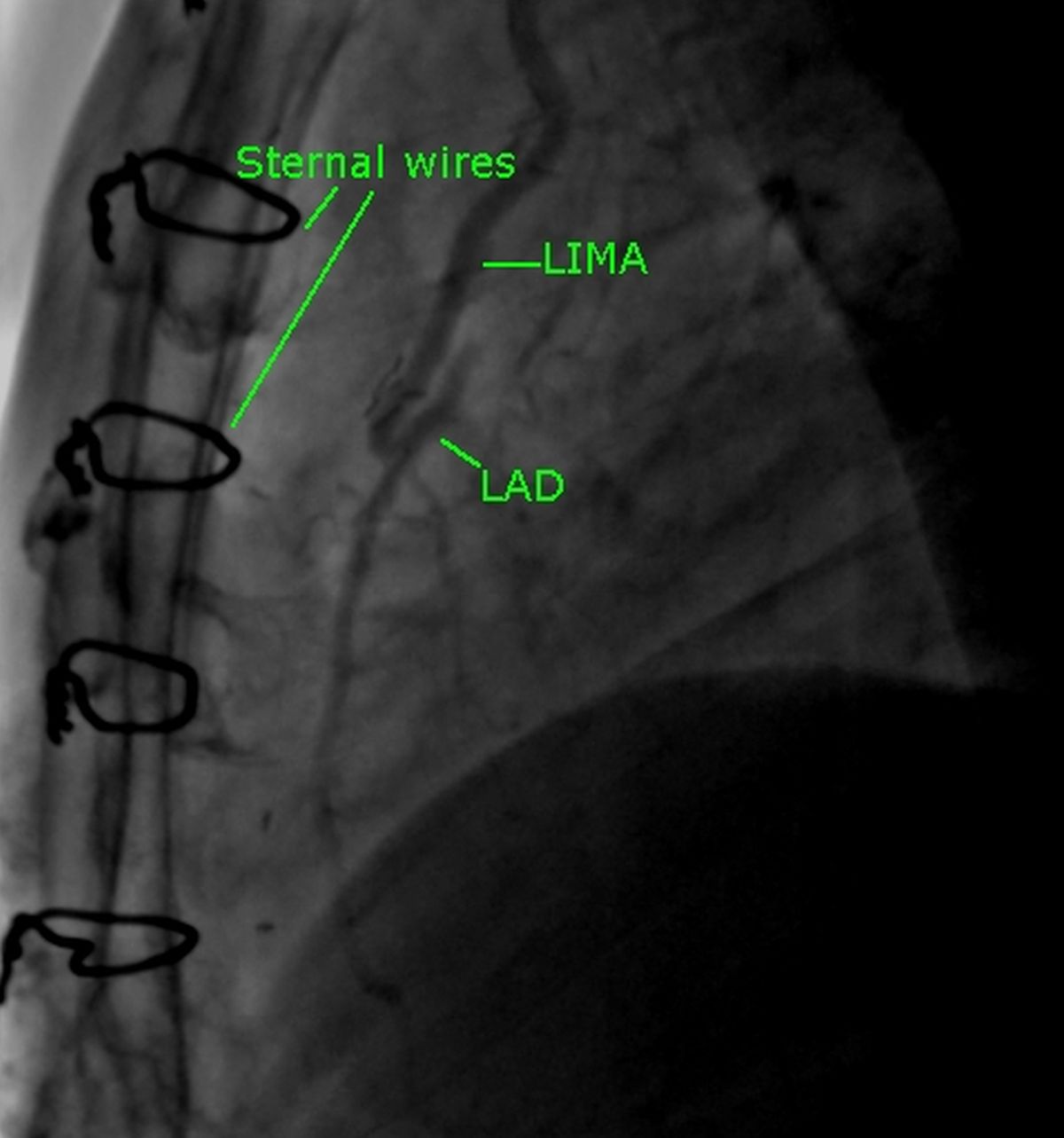 LIMA to LAD coronary bypass graft in lateral view