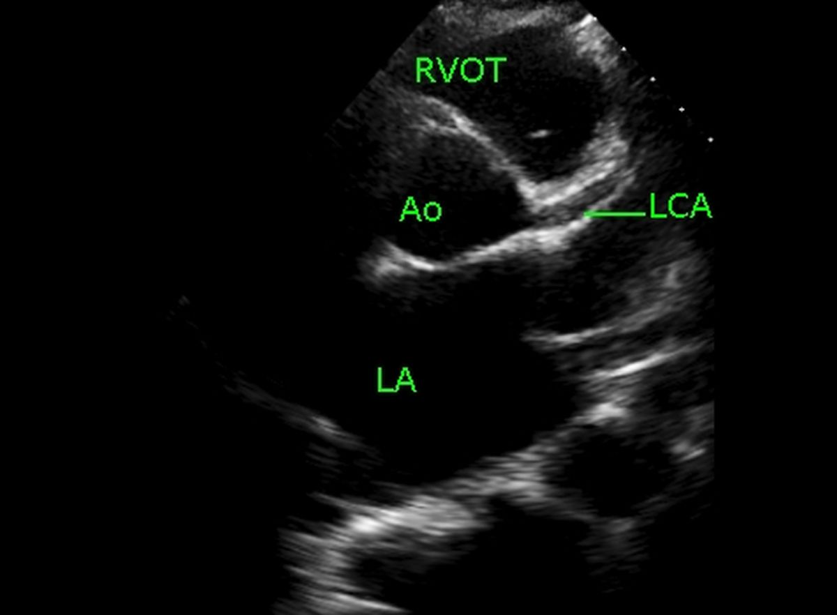 Proximal left coronary artery on echocardiogram