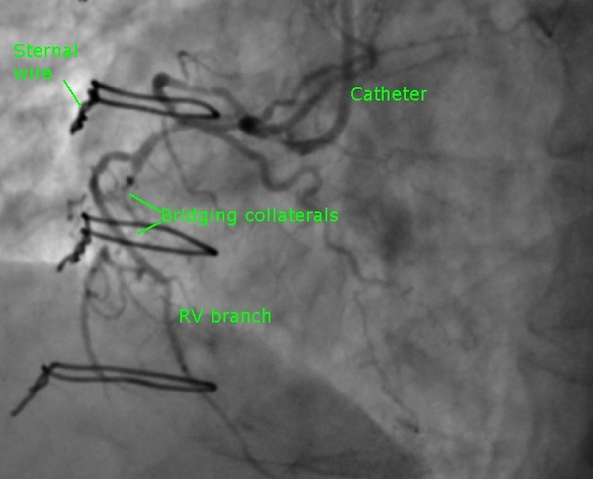 Bridging collaterals on coronary angiogram