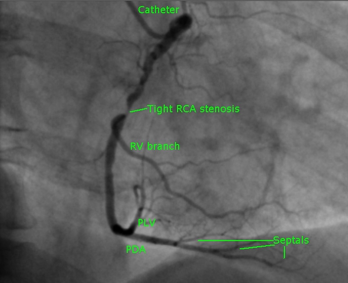 Right coronary angiogram in RAO view
