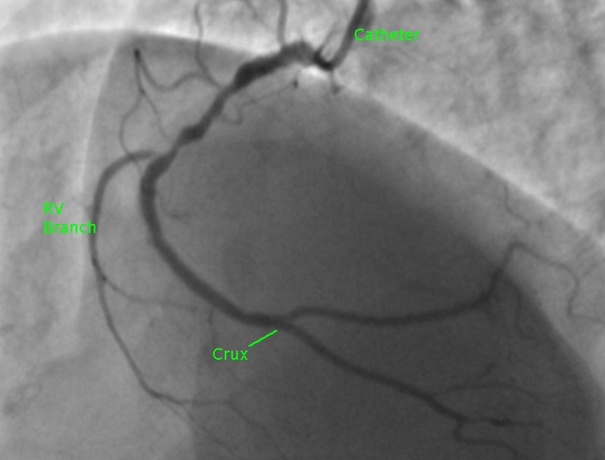 Right coronary artery stenosis