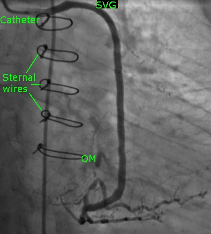 SVG (saphenous vein graft) to obtuse marginal (OM) branch