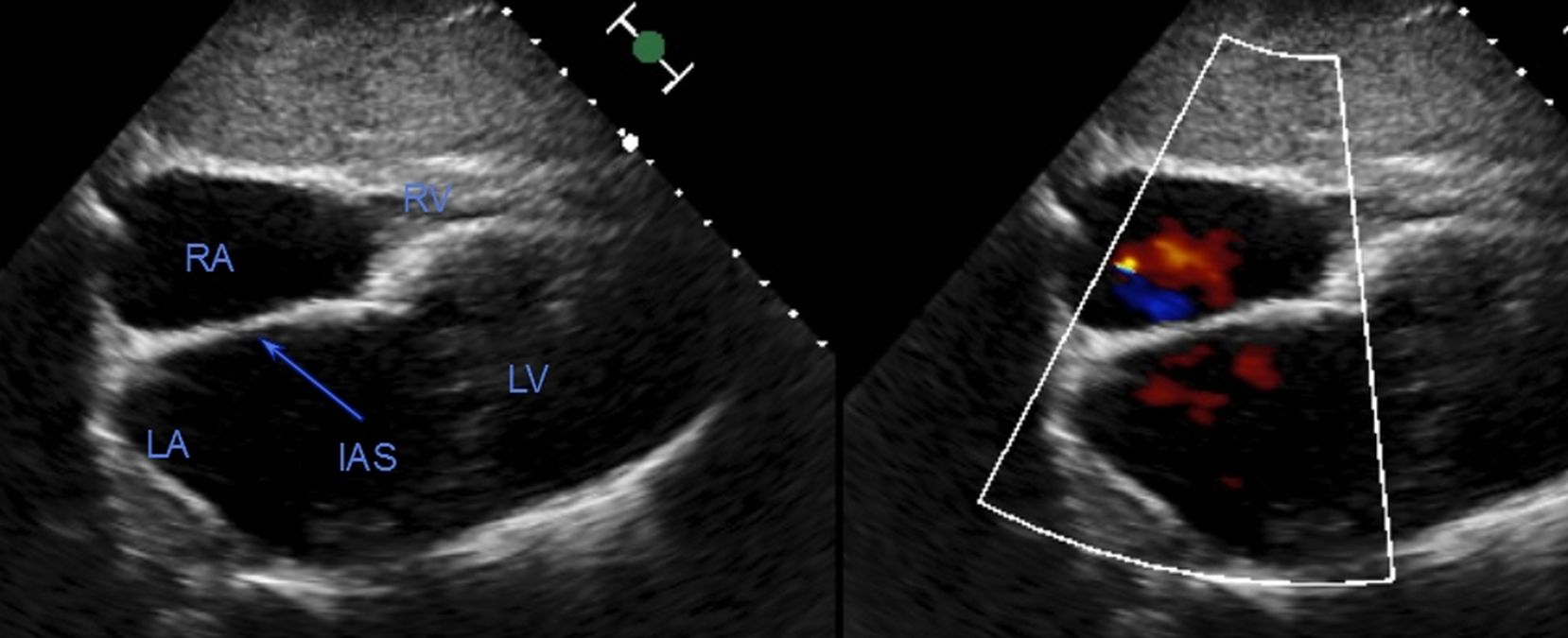Subcostal four chamber view – Echocardiography