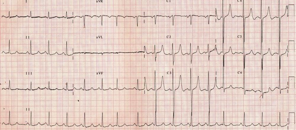 The T-Wave Explained - What Do T Waves On An ECG Represent?