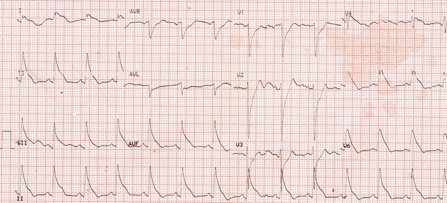 Very wide QRS complex