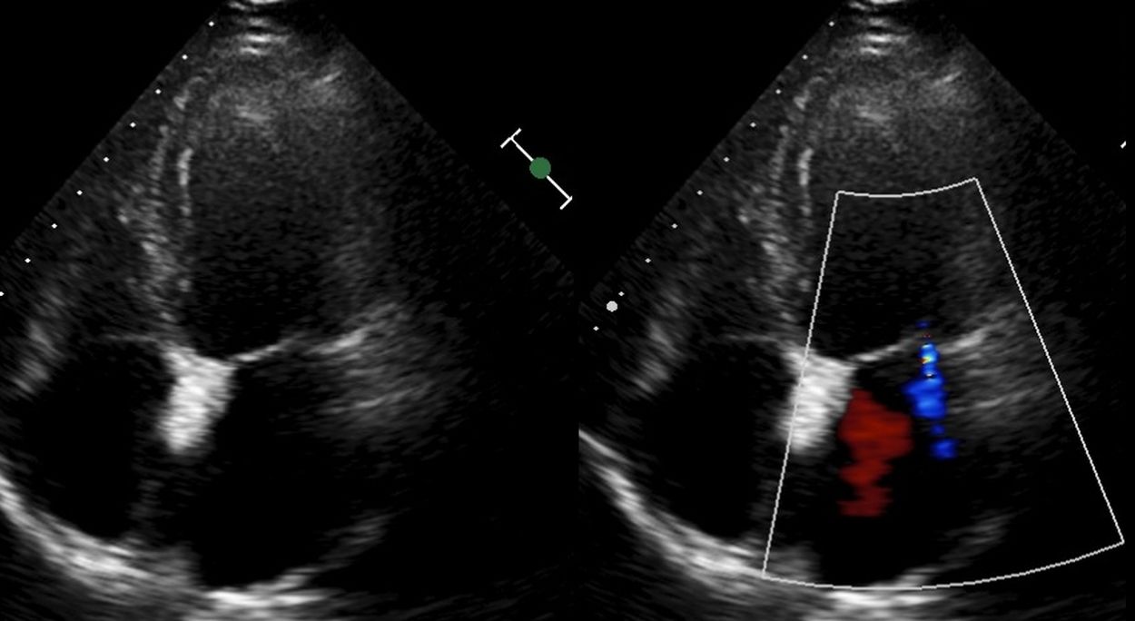 Mitral regurgitation