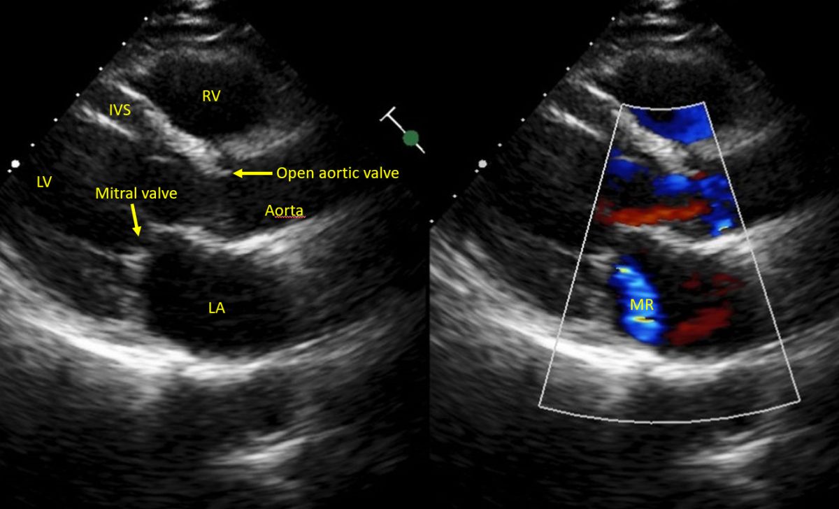 Mitral Regurgitation In Plax And Apical 4c Views All About