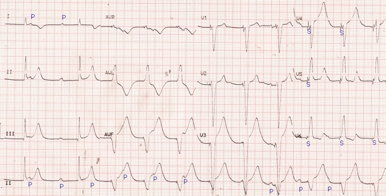 Pacing in complete heart block – ECG – All About Cardiovascular System ...