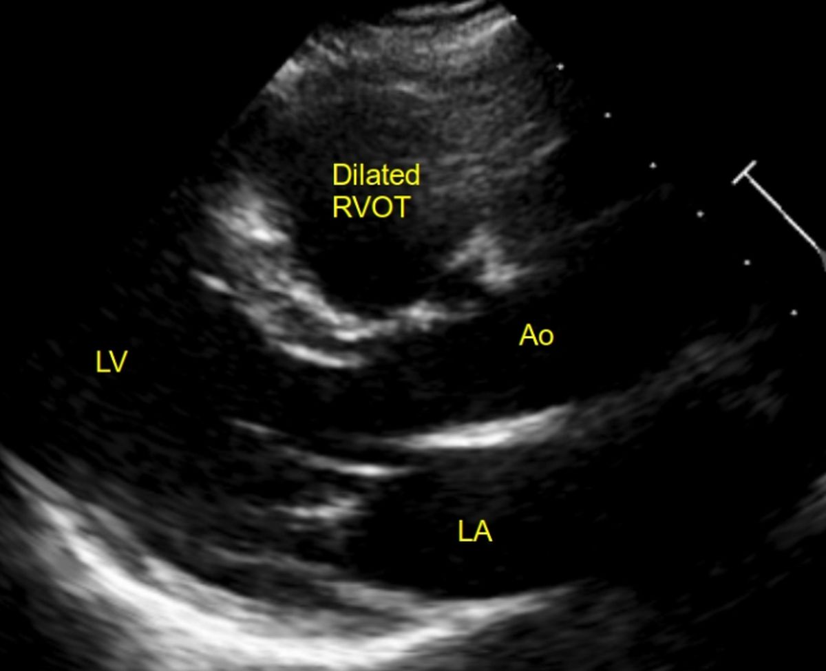 Multiple echo views in EMF - dilated RVOT