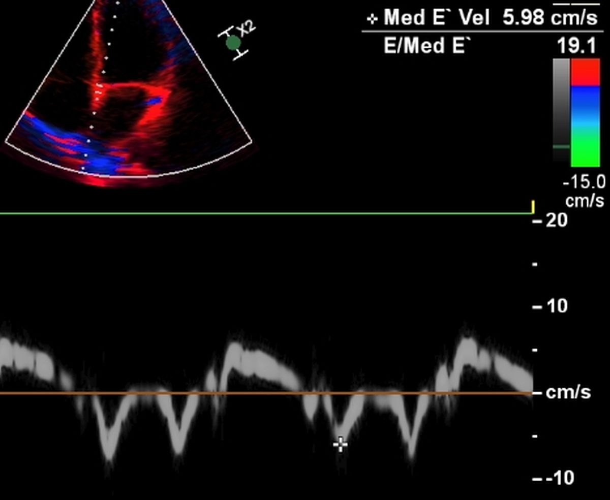Doppler and tissue Doppler in left ventricular diastolic dysfunction