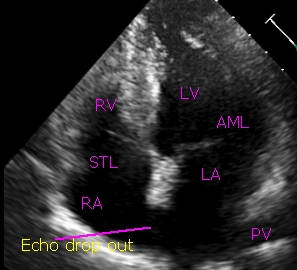 Echo drop out in interatrial septum