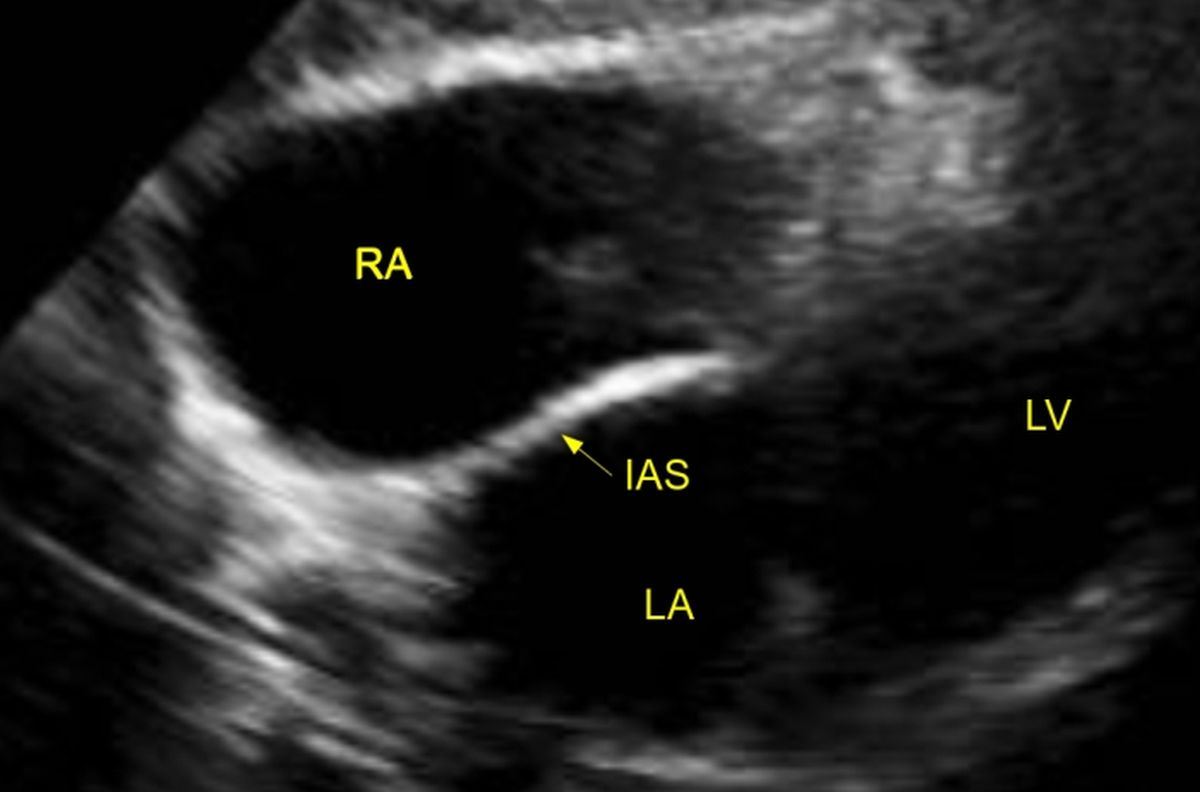 Interatrial septum in subcostal view