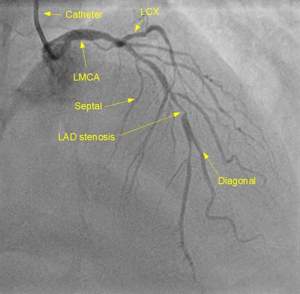 Left coronary angiogram showing stenosis of left anterior descending artery