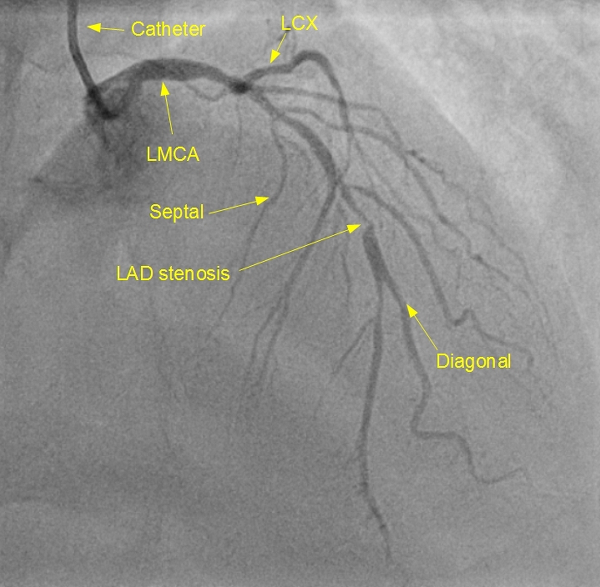 Left coronary angiogram