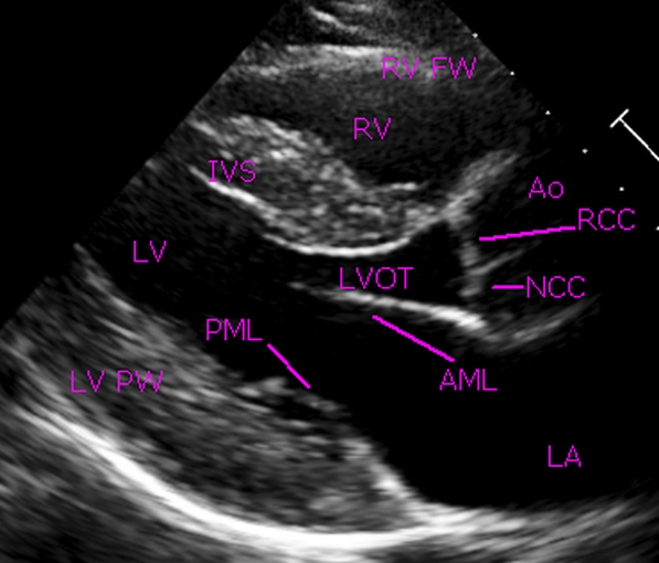 Parasternal long axis view in normal echocardiogram